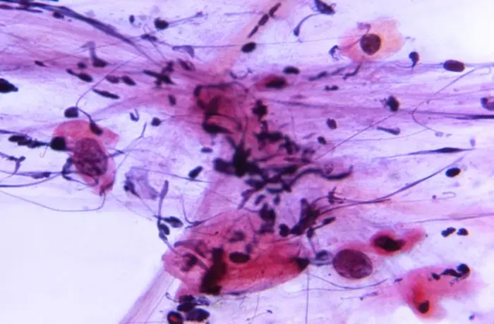 Public-domain photomicrograph of a Pap test showing cellular findings associated with a high-grade squamous intraepithelial lesion